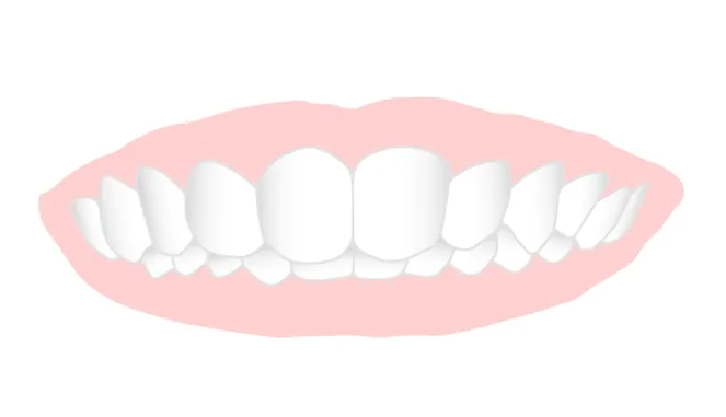 咬み合わせが深い（過蓋咬合）